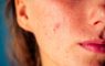 post-acne, scars and red festering pimples on the face of a young woman. concept of skin problems and harmonic failure
